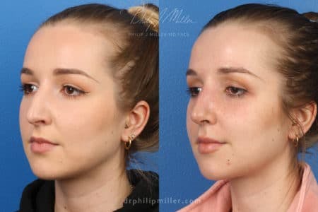 Rhinoplasty/NatraNose Before & After Gallery - Patient 37904512 - Image 4