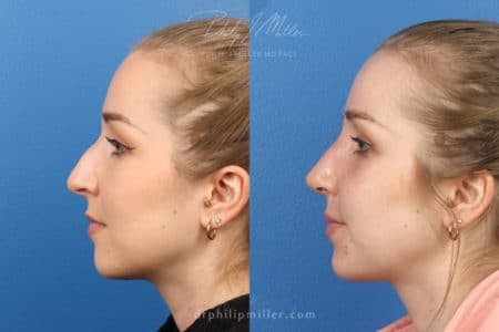 Rhinoplasty/NatraNose Before & After Gallery - Patient 37904512 - Image 5