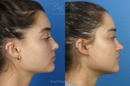 Rhinoplasty/NatraNose Before & After Gallery - Patient 37904543 - Image 1