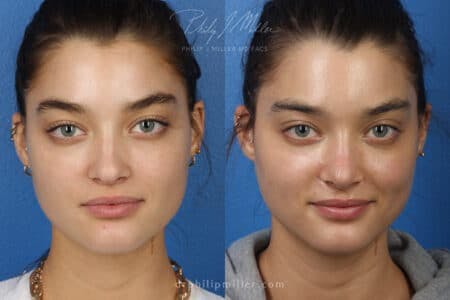 Rhinoplasty/NatraNose Before & After Gallery - Patient 37904543 - Image 3