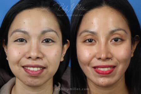 Rhinoplasty/NatraNose Before & After Gallery - Patient 37904575 - Image 1