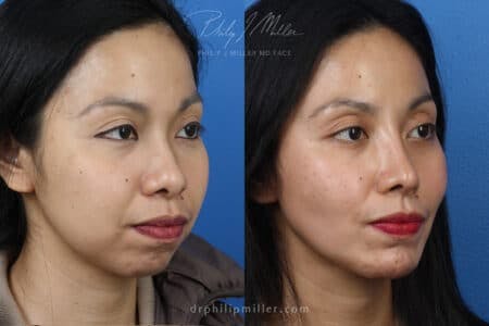 Rhinoplasty/NatraNose Before & After Gallery - Patient 37904575 - Image 2