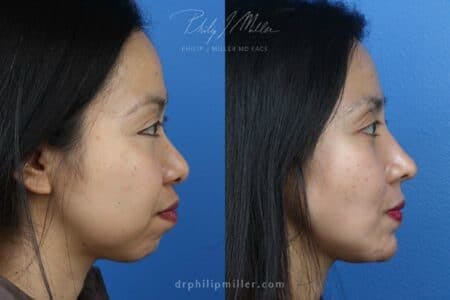 Rhinoplasty/NatraNose Before & After Gallery - Patient 37904575 - Image 3