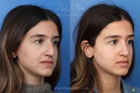 Rhinoplasty/NatraNose Before & After Gallery - Patient 37904594 - Image 1