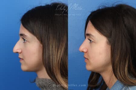 Rhinoplasty/NatraNose Before & After Gallery - Patient 37904594 - Image 2