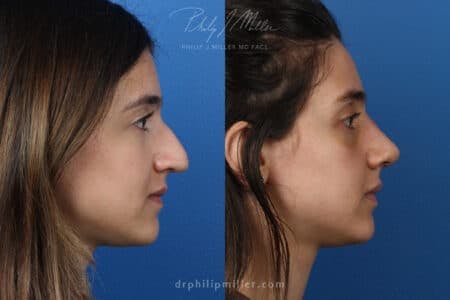 Rhinoplasty/NatraNose Before & After Gallery - Patient 37904594 - Image 3