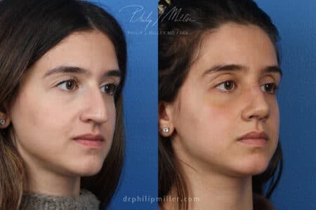 Rhinoplasty/NatraNose Before & After Gallery - Patient 37904594 - Image 4