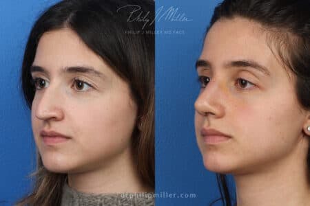 Rhinoplasty/NatraNose Before & After Gallery - Patient 37904594 - Image 5