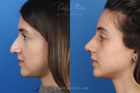 Rhinoplasty/NatraNose Before & After Gallery - Patient 37904594 - Image 6
