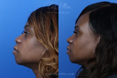 Rhinoplasty/NatraNose Before & After Gallery - Patient 37904627 - Image 1
