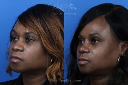 Rhinoplasty/NatraNose Before & After Gallery - Patient 37904627 - Image 2
