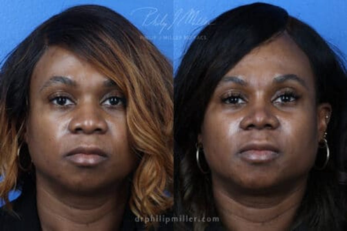 Ethnic Rhinoplasty Before & After Gallery - Patient 37903648 - Image 3