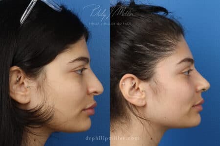 Rhinoplasty/NatraNose Before & After Gallery - Patient 37904641 - Image 1