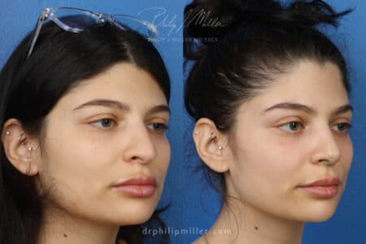 Ethnic Rhinoplasty Before & After Gallery - Patient 37903663 - Image 2