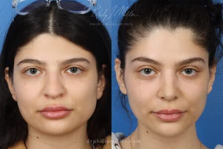 Rhinoplasty/NatraNose Before & After Gallery - Patient 37904641 - Image 3