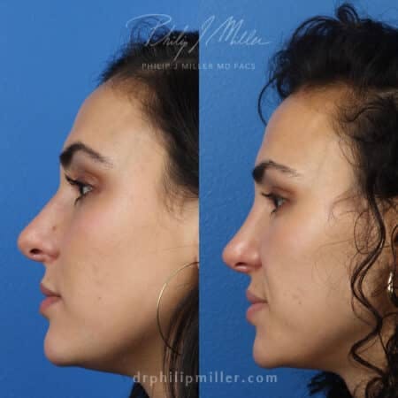 Rhinoplasty/NatraNose Before & After Gallery - Patient 37904656 - Image 1