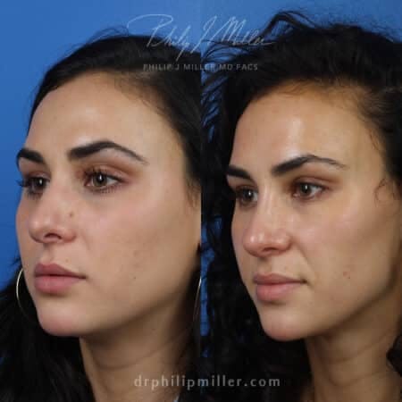Rhinoplasty/NatraNose Before & After Gallery - Patient 37904656 - Image 2
