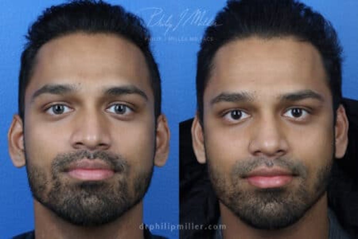 Ethnic Rhinoplasty Before & After Gallery - Patient 37903681 - Image 2
