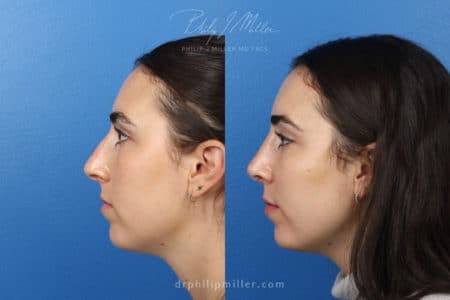 Rhinoplasty/NatraNose Before & After Gallery - Patient 37904671 - Image 1