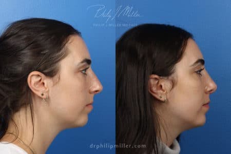 Rhinoplasty/NatraNose Before & After Gallery - Patient 37904671 - Image 2