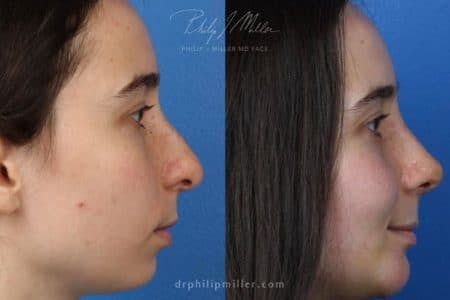 Rhinoplasty/NatraNose Before & After Gallery - Patient 37904677 - Image 1