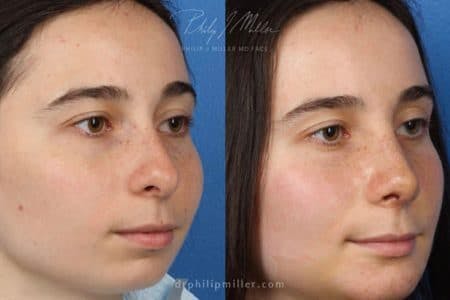 Rhinoplasty/NatraNose Before & After Gallery - Patient 37904677 - Image 2