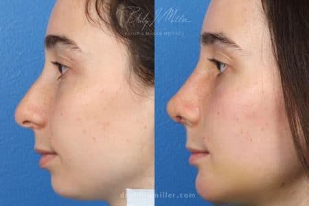 Rhinoplasty/NatraNose Before & After Gallery - Patient 37904677 - Image 3