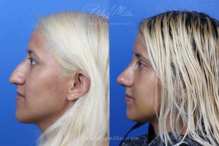 Rhinoplasty/NatraNose Before & After Gallery - Patient 37904689 - Image 1