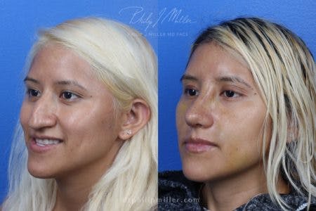 Rhinoplasty/NatraNose Before & After Gallery - Patient 37904689 - Image 2