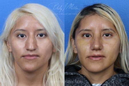 Rhinoplasty/NatraNose Before & After Gallery - Patient 37904689 - Image 3