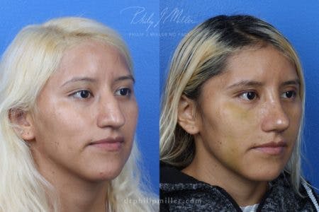 Rhinoplasty/NatraNose Before & After Gallery - Patient 37904689 - Image 4
