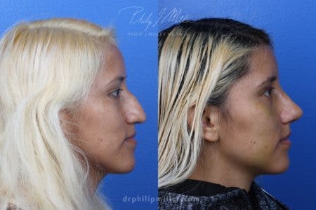 Rhinoplasty/NatraNose Before & After Gallery - Patient 37904689 - Image 5