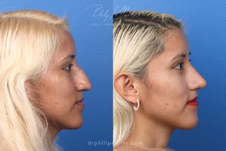 Rhinoplasty/NatraNose Before & After Gallery - Patient 37904689 - Image 6