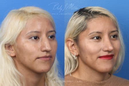 Rhinoplasty/NatraNose Before & After Gallery - Patient 37904689 - Image 7