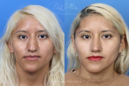 Rhinoplasty/NatraNose Before & After Gallery - Patient 37904689 - Image 8