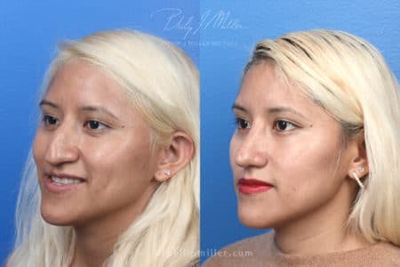 Rhinoplasty/NatraNose Before & After Gallery - Patient 37904689 - Image 9