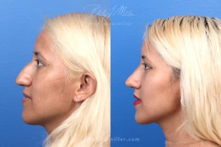 Rhinoplasty/NatraNose Before & After Gallery - Patient 37904689 - Image 10