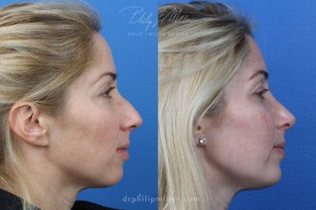 Rhinoplasty/NatraNose Before & After Gallery - Patient 37904703 - Image 1
