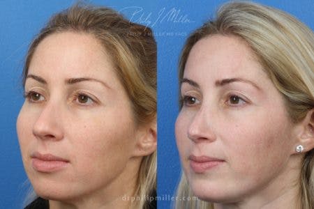 Rhinoplasty/NatraNose Before & After Gallery - Patient 37904703 - Image 2