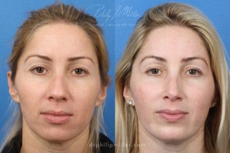 Rhinoplasty/NatraNose Before & After Gallery - Patient 37904703 - Image 3