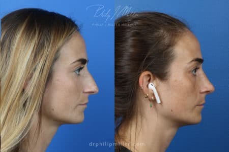 Rhinoplasty/NatraNose Before & After Gallery - Patient 37904706 - Image 2