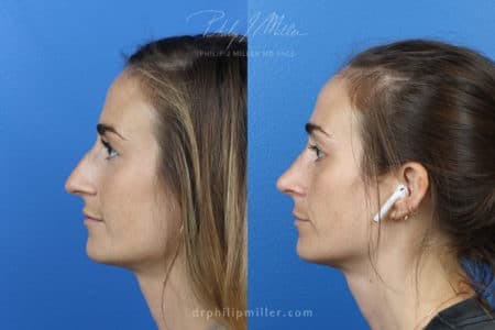 Rhinoplasty/NatraNose Before & After Gallery - Patient 37904706 - Image 3