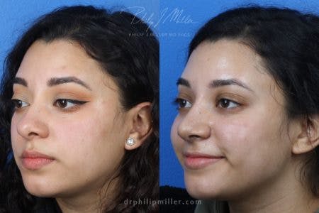 Rhinoplasty/NatraNose Before & After Gallery - Patient 37904711 - Image 2