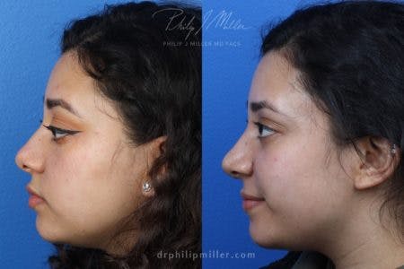 Rhinoplasty/NatraNose Before & After Gallery - Patient 37904711 - Image 1