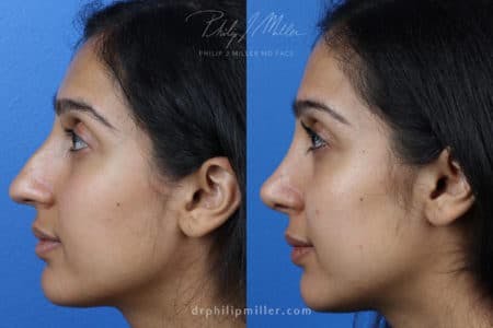 Rhinoplasty/NatraNose Before & After Gallery - Patient 37904719 - Image 1