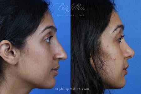 Rhinoplasty/NatraNose Before & After Gallery - Patient 37904719 - Image 2
