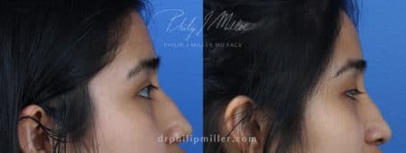 Rhinoplasty/NatraNose Before & After Gallery - Patient 37904719 - Image 3