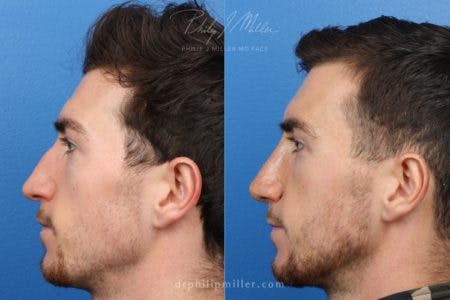 Rhinoplasty/NatraNose Before & After Gallery - Patient 37904722 - Image 1