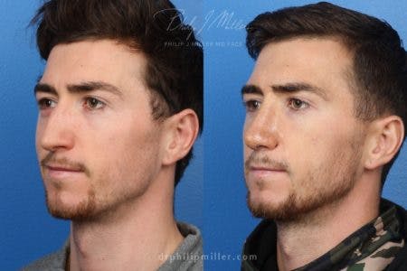 Rhinoplasty/NatraNose Before & After Gallery - Patient 37904722 - Image 2