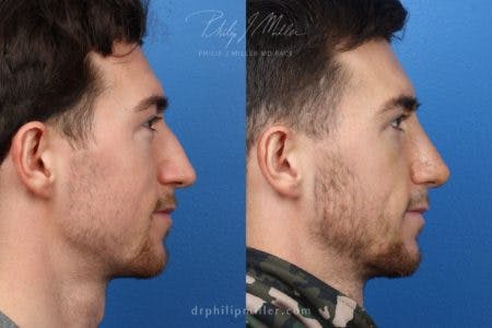 Rhinoplasty/NatraNose Before & After Gallery - Patient 37904722 - Image 3